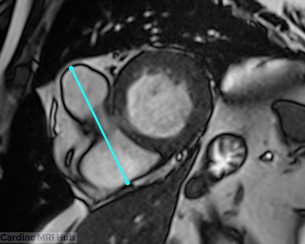 Cardiac MRI basal short axis view with right atrium bisected for RV inflow planning on 1.5T scanner