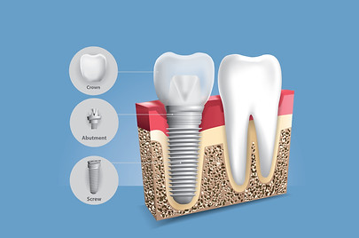 Revive Dental of Lewisville, TX 75067 Family, Cosmetic, Emergency, Implants Dentist - Dental Checkup, Cleaning and Examinations, Crowns, Bridges, Implants, Restorations, Veneers, Tooth Extractions, Teeth Whitening, Dentures, Partial Dentures, Emergency Dentist, Invisalign Dentist, Kid Friendly Dentist, Periodontics, Root Canal Therapy