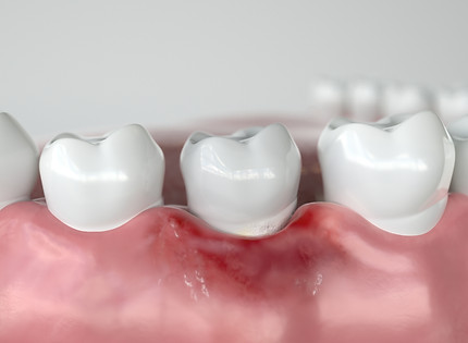 Revive Dental in Irving, TX 75062 Family, Cosmetic, Emergency, Implants Dentist - Dental Checkup, Cleaning and Examinations, Crowns, Bridges, Implants, Restorations, Veneers, Tooth Extractions, Teeth Whitening, Dentures, Partial Dentures, Emergency Dentist, Invisalign Dentist, Kid Friendly Dentist, Periodontics, Root Canal Therapy