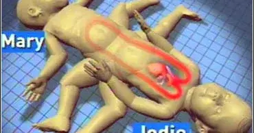 If Saving One Means Losing Another, What Would You Do?: Jodie and Mary’s Conjoined Twins Case