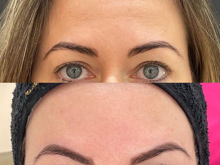 6 razões para você fazer botox!