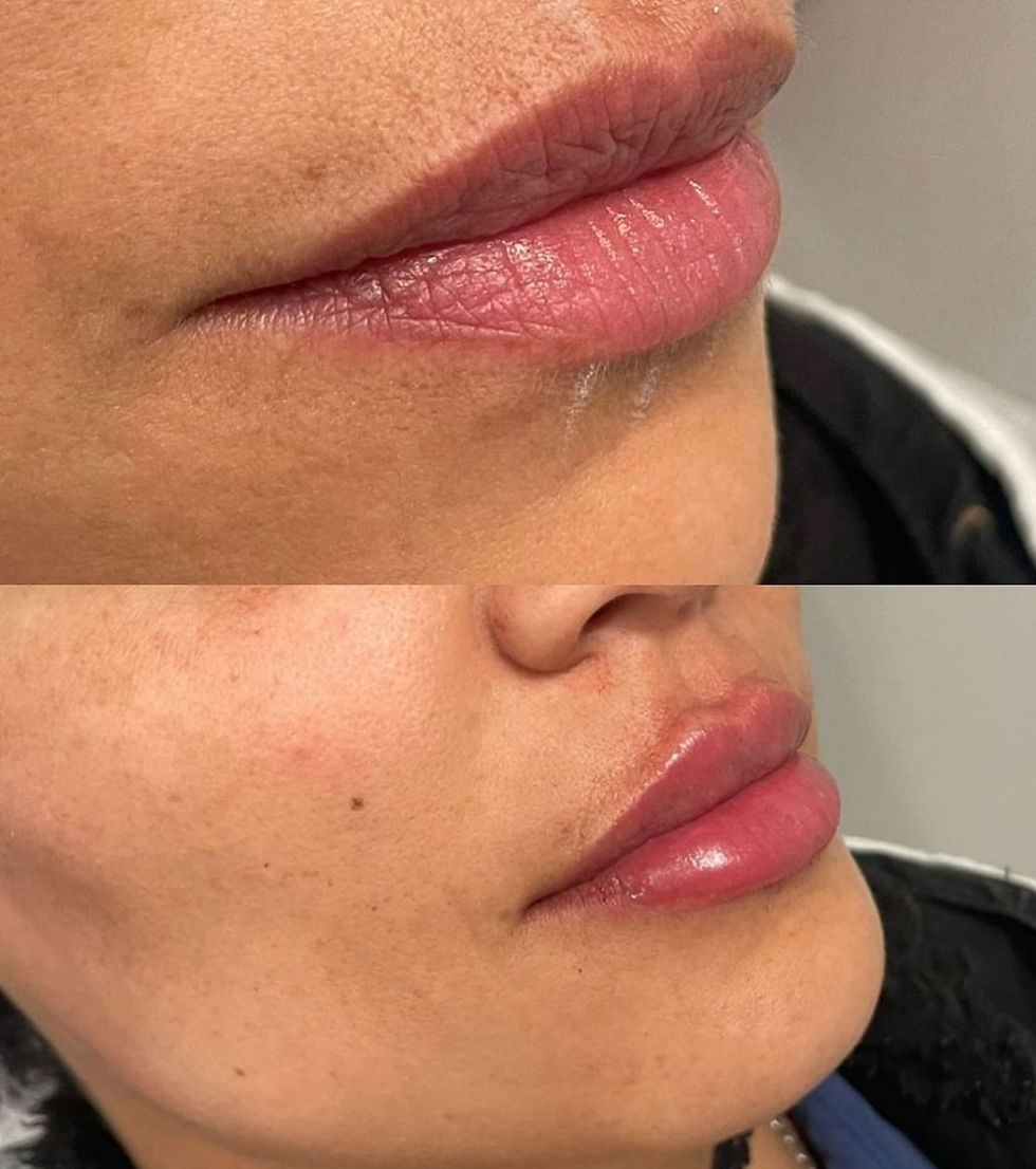Preenchimento labial