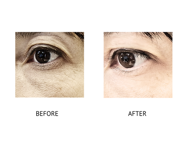 before and after eyes