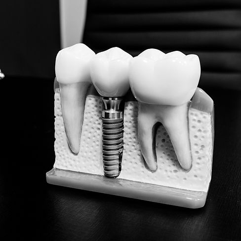 DENTAL İMPLANT.jpg