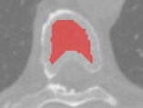 tabecular.PNG