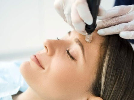 Microneedling