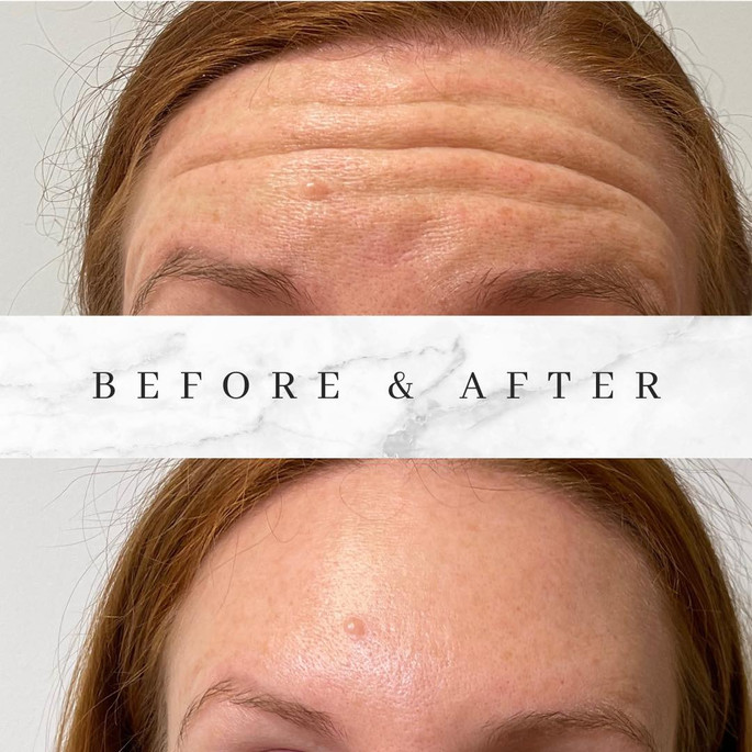 Botox Transformations | Grace And Glow Md