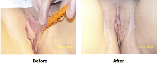Labioplasty-shortening of Labia Minora