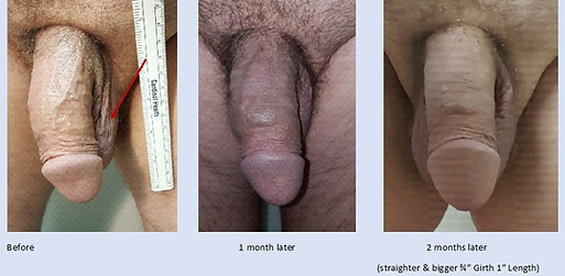 Peyronie's Disease treated with PRP