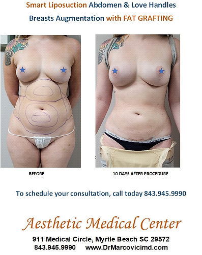 Smart Liposuction and Breasts Fat Grafting.jpg