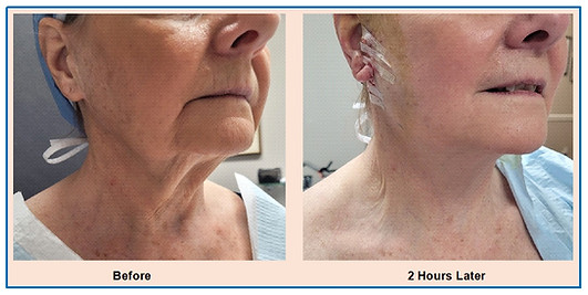 Neck and Lower Face Lift jan 2025.jpg