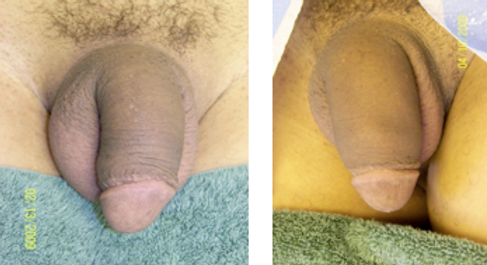 Penis girth enlargement