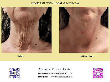 Face Neck Lift.jpg