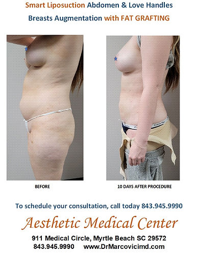 Smart Liposuction and Breasts Fat Grafting. Lateral View.jpg