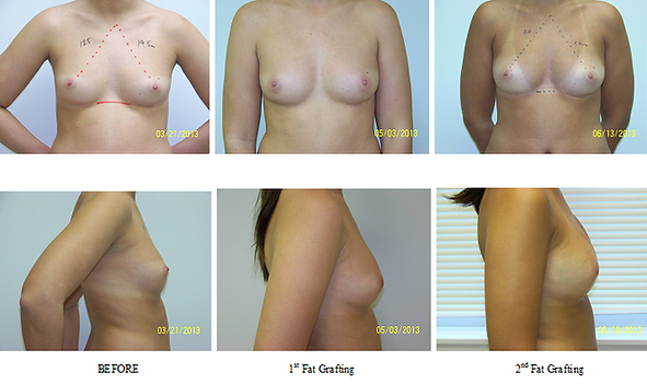 Breasts Enlargement with Serial Fat Grafting