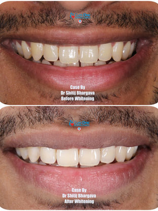 Teeth Whitening at Cure One Dental Clinic Bhopal