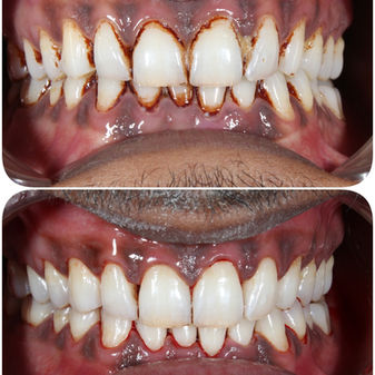 Touchless Teeth Cleaning at Cure One Dental Clinic Bhopal