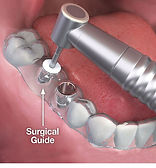 implant-surgical-guide.jpg