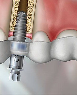 guided-implant-500x400.jpeg