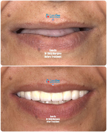 Dental Implants at Cure One Dental Clinic Bhopal