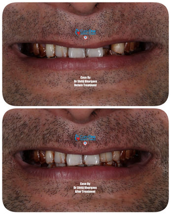 Dental Implants at Cure One Dental Clinic Bhopal