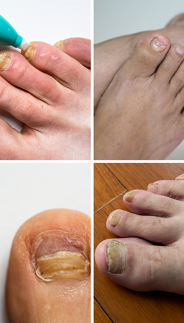 Collage of four images showing Foot Corns