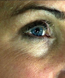 1 - DERMAFRAC BEFORE.jpg
