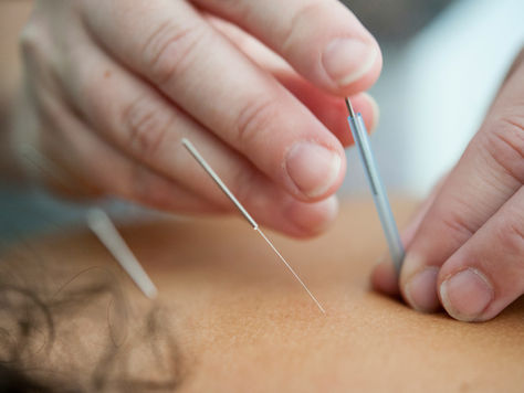 Can Acupuncture Help with Migraines?