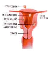 Fibromi