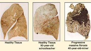 Πνευμονολογικές και καρδιαγγειακές επιπτώσεις της αιθαλομίχλης