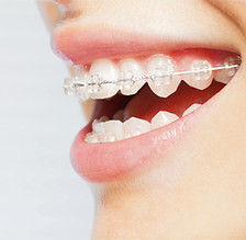 Braces Smile_edited_edited.jpg