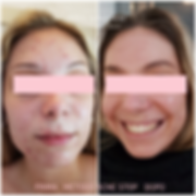 Acne Stop Sara Post (FILEminimizer).png