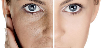 traitement des pores dilatés par peeling