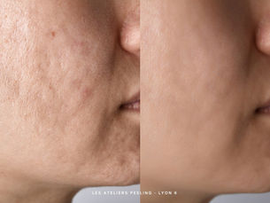 peeling-visage-pour-traitement-cicatrices-acné-lyon