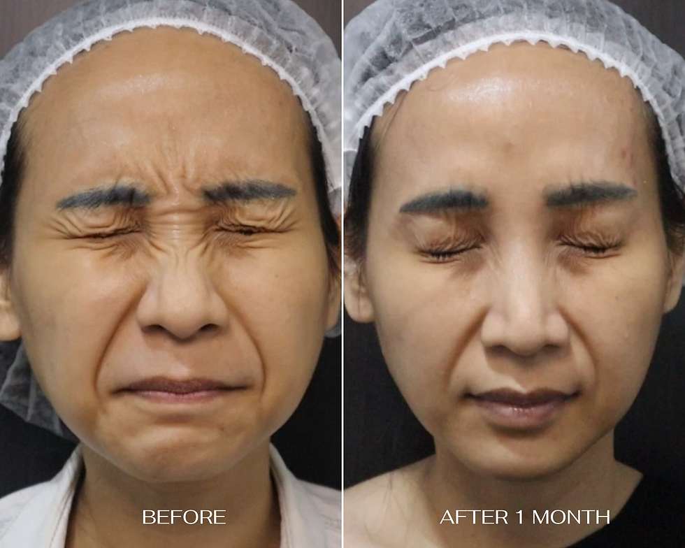 Botox Upper Face