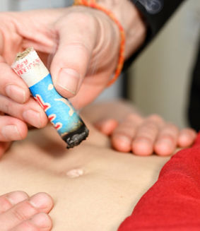 moxibustion moxa acupuncture
