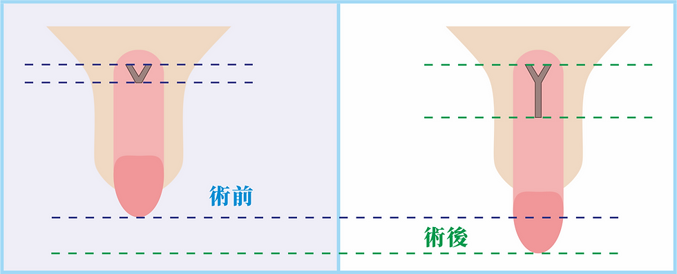 V-Y皮瓣延長術前術後示意圖