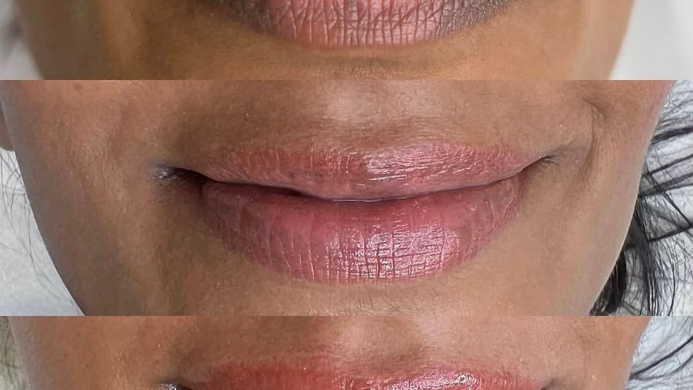 Before and after picture of lip neutralisation 