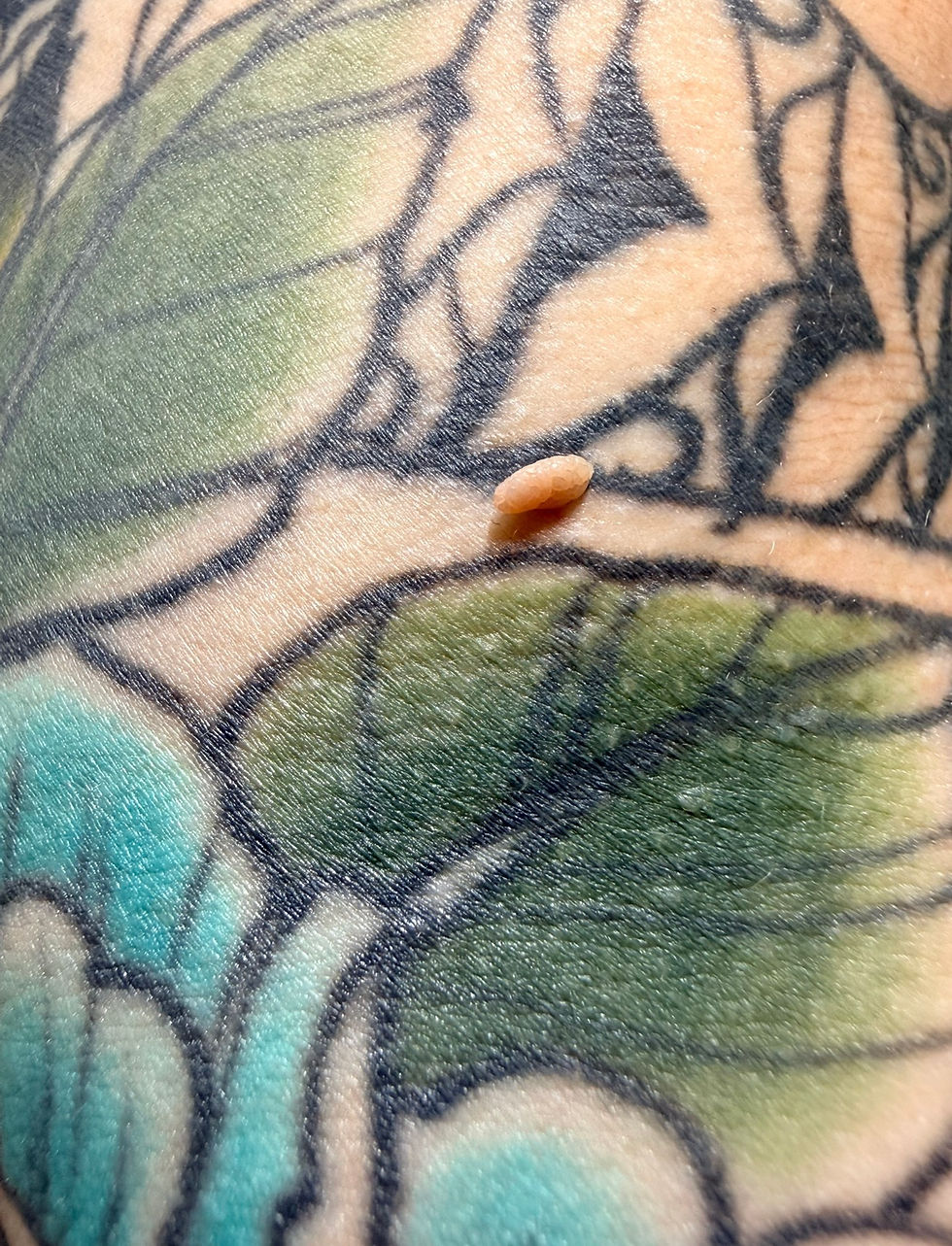 Why Do Skin Tags Appear? Common Causes Explained
