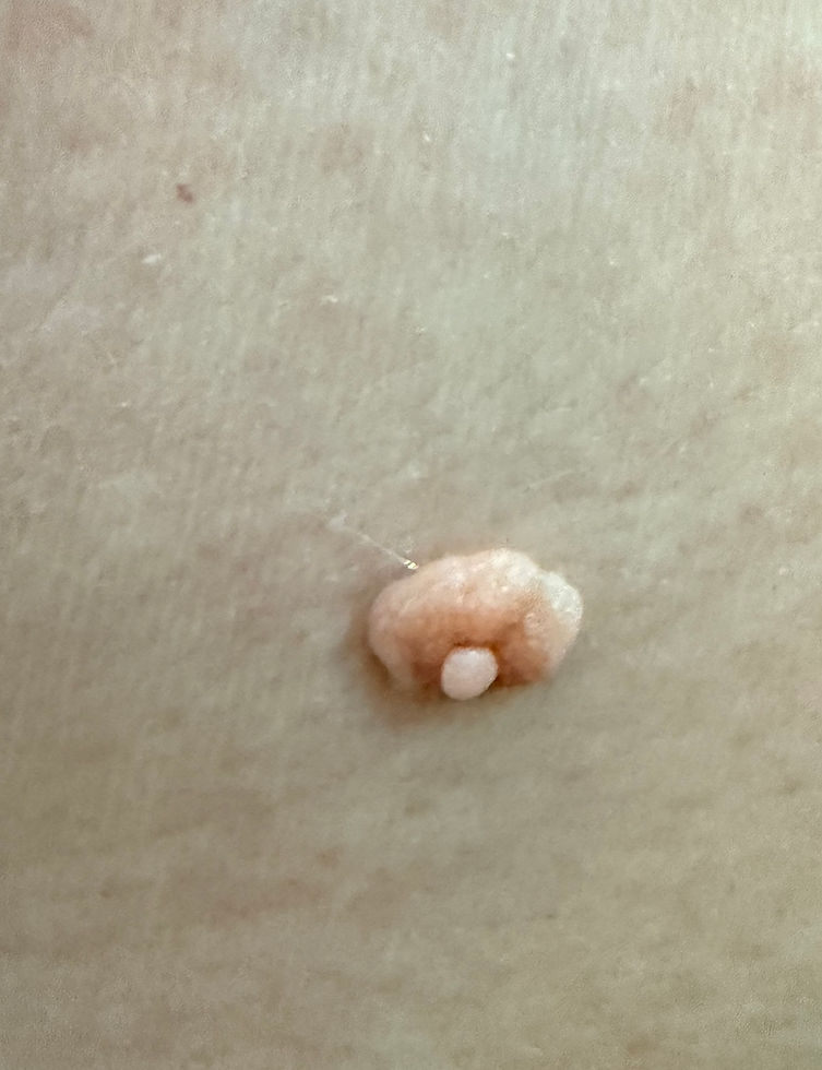 Can I get rid of a skin tag—or am I stuck with it?