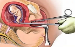 Dilator_edited_edited_edited_edited_edit