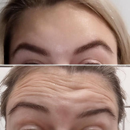 Botox.jpeg