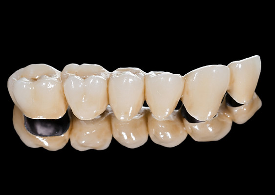 PFM_ceramic