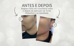 Aplicacão de Ácido Hialurônico