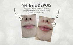 Preenchimento Labial