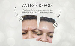 Antes e Depois - Dra. Jacqueline