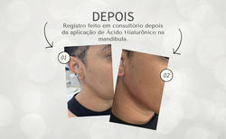 Aplicação de Ácido Hialurônico