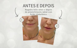 Preenchimento Labial