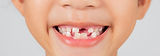 sourire d'un enfant aant perdu des dents de lait