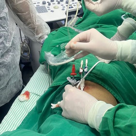 Santa Casa realiza primeiro implante de cateter de hemodiálise transhepático da região